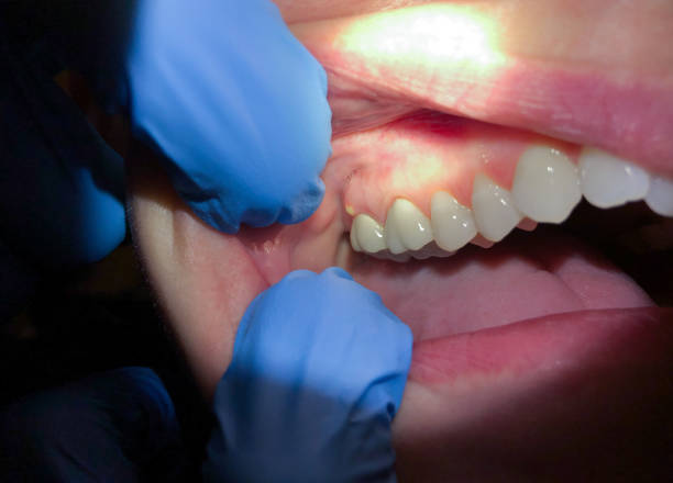 Best Emergency Denture Repair in Ridge, NY